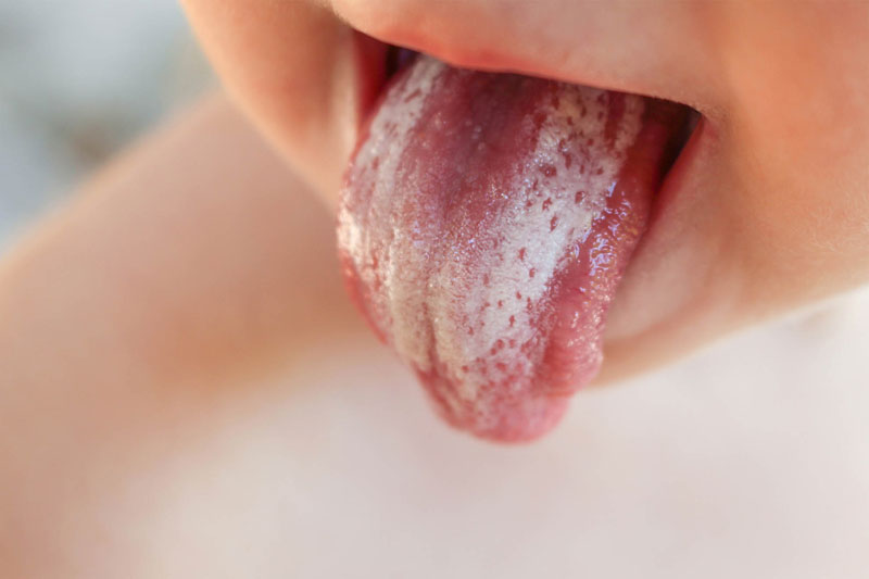 Khi trẻ bị trắng lưỡi có rất nhiều đốm trắng xuất hiện trên bề mặt lưỡi.