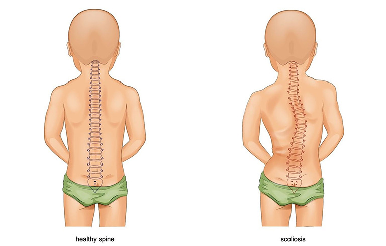 3 Bệnh Về Xương Khớp Thường Gặp ở Trẻ Cha Mẹ Cần Chú ý 